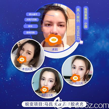 张慧慧医生自体脂肪填充全脸效果图 张慧慧医生自体脂肪填充全脸效果图