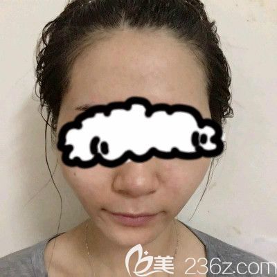 赣州叶子医疗美容钟林辉给我做自体脂肪填充全脸术前的我 赣州叶子医疗美容钟林辉给我做自体脂肪填充全脸术前的我