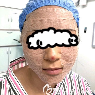 赣州叶子医疗美容钟林辉给我做自体脂肪填充全脸术后即刻效果图 赣州叶子医疗美容钟林辉给我做自体脂肪填充全脸术后即刻效果图