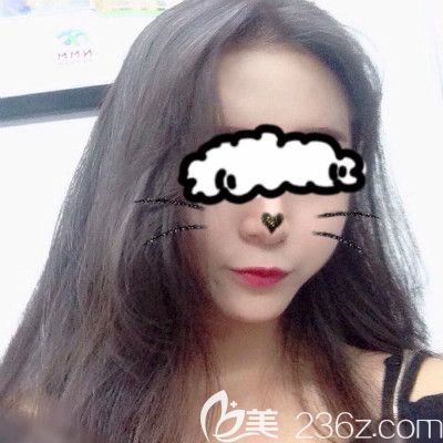 赣州叶子医疗美容钟林辉给我做自体脂肪填充全脸术后第20天照片 赣州叶子医疗美容钟林辉给我做自体脂肪填充全脸术后第20天照片