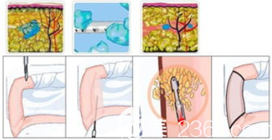 手臂吸脂手术过程图
