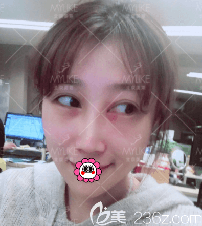 叶宇医生给我做眶隔脂肪释放和祛眼袋第7天样子