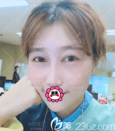 北京美莱做眼睛好的叶宇医生给我做眶隔脂肪释放和祛眼袋一个月效果