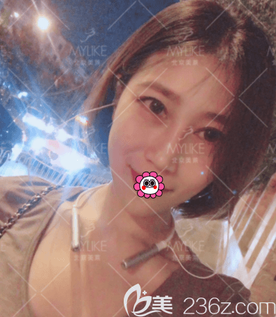 北京美莱叶宇医生眶隔脂肪释放+内路祛眼袋案例