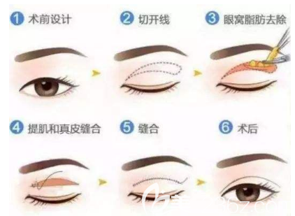 全切双眼皮手术流程
