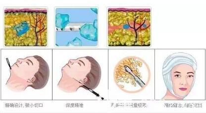 面部吸脂手术过程示意图