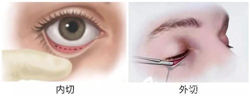 内切去眼袋和外切祛眼袋手术切口位置