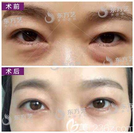 信阳东方艺整形祛眼袋真人案例