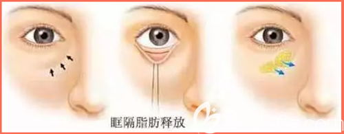 眶隔释放法去眼袋手术过程