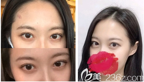 什么是双眼皮线条 20190911_1568195821550377.png