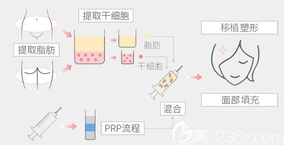 整形医院面部脂肪填充原理图 整形医院面部脂肪填充原理图