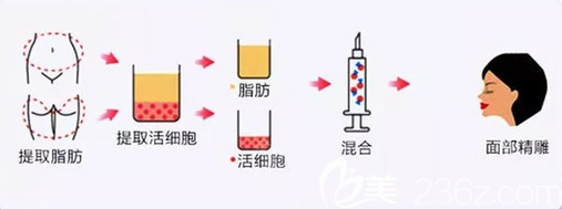 自体脂肪填充面部手术过程图