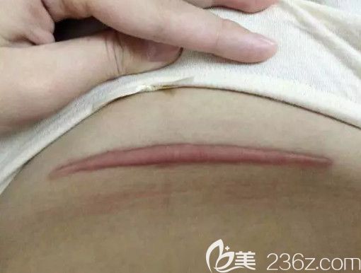 剖腹产疤痕增生的样子