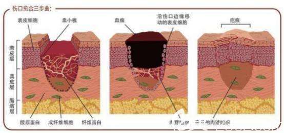 剖腹产疤痕增生产生的原因