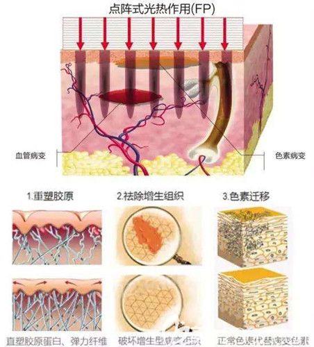 激光祛除剖腹产疤痕增生