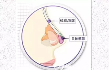 耳软骨隆鼻 耳软骨隆鼻