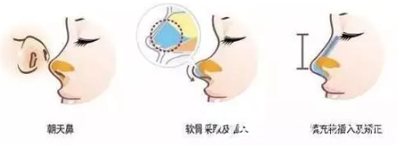 短鼻朝天鼻 短鼻朝天鼻