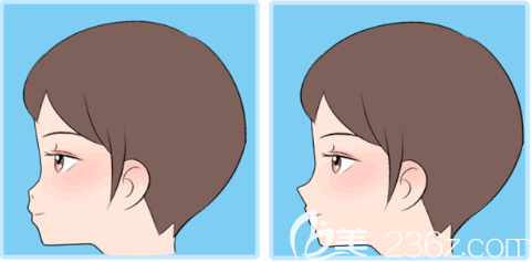 鼻头肥大 鼻头肥大