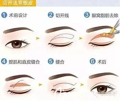 信阳易韩安和擅长项目：全切双眼皮
