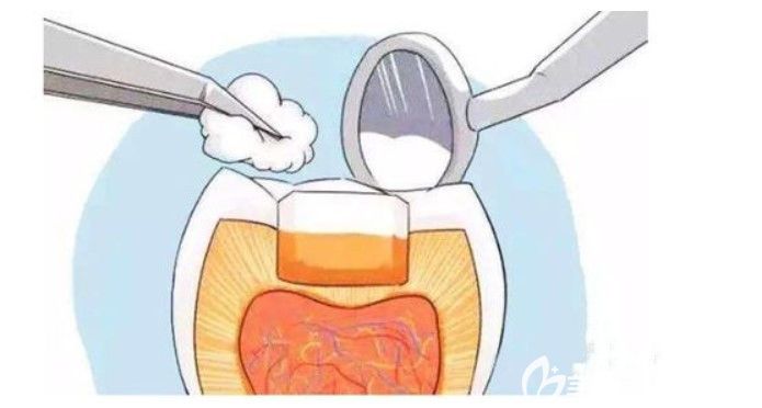 天津爱齿口腔袁新明医生告诉你牙齿坏了怎么办 天津爱齿口腔袁新明医生告诉你牙齿坏了怎么办