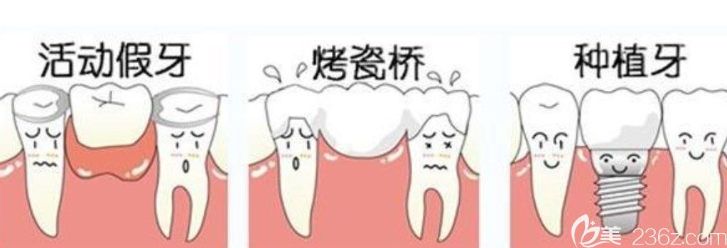 袁新明说牙齿坏了具体怎么修复需要根据牙齿损坏的程度