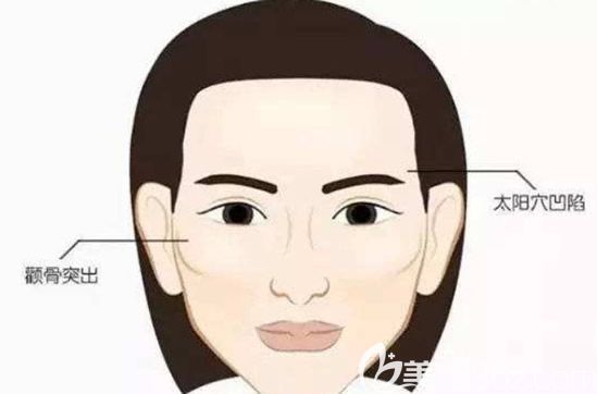 高颧骨的女人一般都有太阳穴凹陷的症状 高颧骨的女人一般都有太阳穴凹陷的症状
