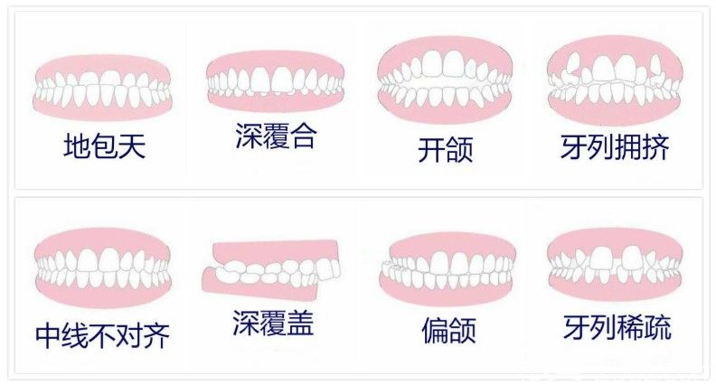 天津爱齿口腔党雄英医生解析牙齿畸形是什么原因造成的