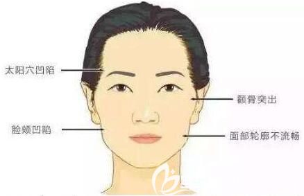 自体脂肪填充额头