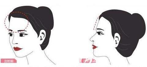 自体脂肪填充额头原理