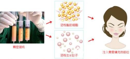 自体脂肪填充额头后为什么有些人会像寿星一样呢？