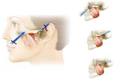 磨骨瘦脸有危险吗？