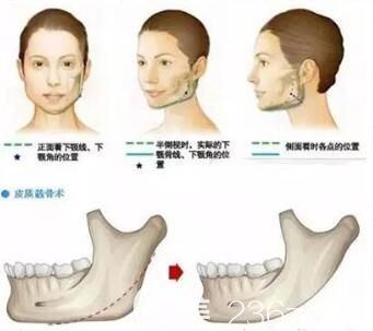磨骨瘦脸后遗症