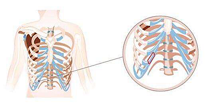 肋软骨隆鼻的手术原理