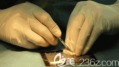 肋软骨隆鼻的优势