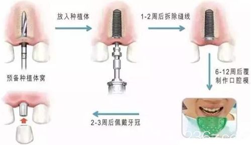 种植牙的种植修复过程图 种植牙的种植修复过程图