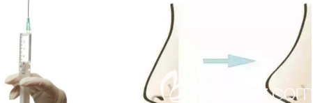 注射隆鼻示意图 注射隆鼻示意图