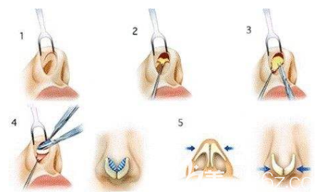 鼻综合整形手术示意图