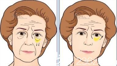 激光去眼袋原理