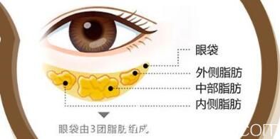 激光去眼袋副作用
