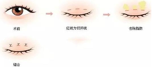 韩式微创双眼皮手术流程示意图
