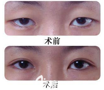 韩式微创双眼皮手术术前术后对比案例图
