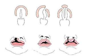 唇腭裂手术示意图