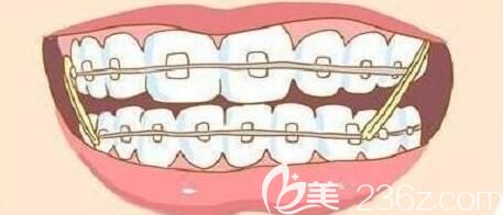 维乐阳光口腔杨唐文医生介绍错颌畸形的矫治方法 维乐阳光口腔杨唐文医生介绍错颌畸形的矫治方法