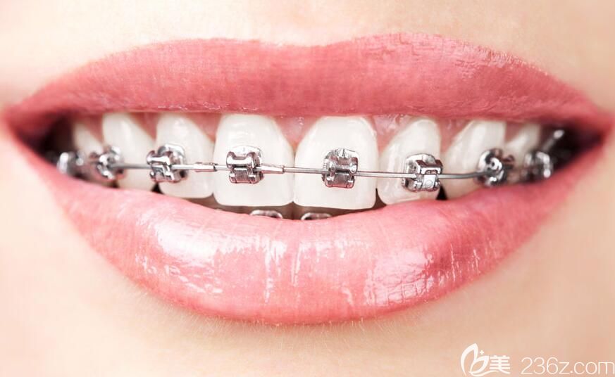 上饶维乐阳光口腔杨凡医生说牙齿矫正要趁早 上饶维乐阳光口腔杨凡医生说牙齿矫正要趁早