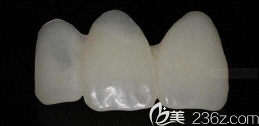 维乐阳光口腔陈德靖介绍前牙贴面的步骤 维乐阳光口腔陈德靖介绍前牙贴面的步骤