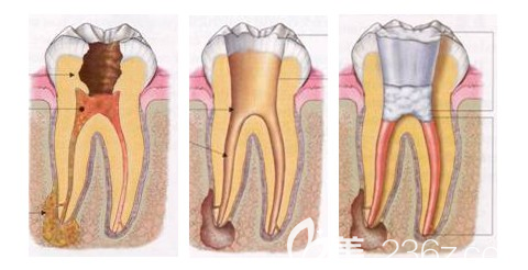 维乐阳光口腔潘穗文介绍牙体牙髓病的治疗方法