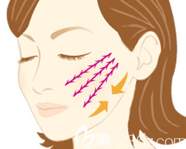 埋线提升多久洗脸可以恢复