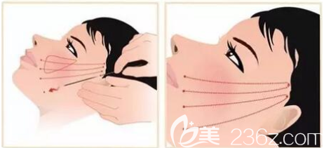 埋线提升手术示意图