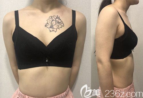 韩国普罗菲耳蓓拉假体隆胸真人案例