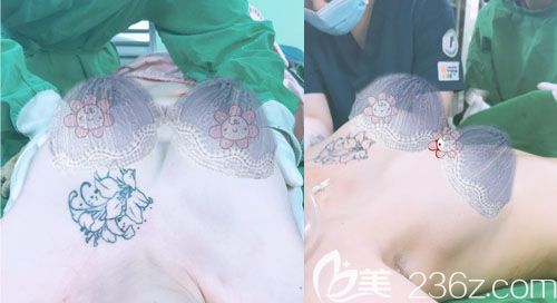 韩国普罗菲耳隆胸手术过程中